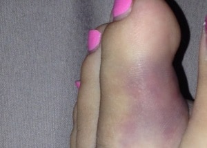 broken toe